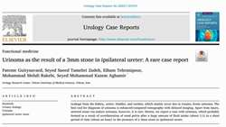 Urinoma as the result of a 3mm stone in ipsilateral ureter: A rare case report